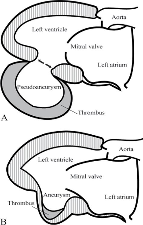 lv aneurysm vs pseudoaneurysm|left ventricular pseudoaneurysm vs aneurysm.